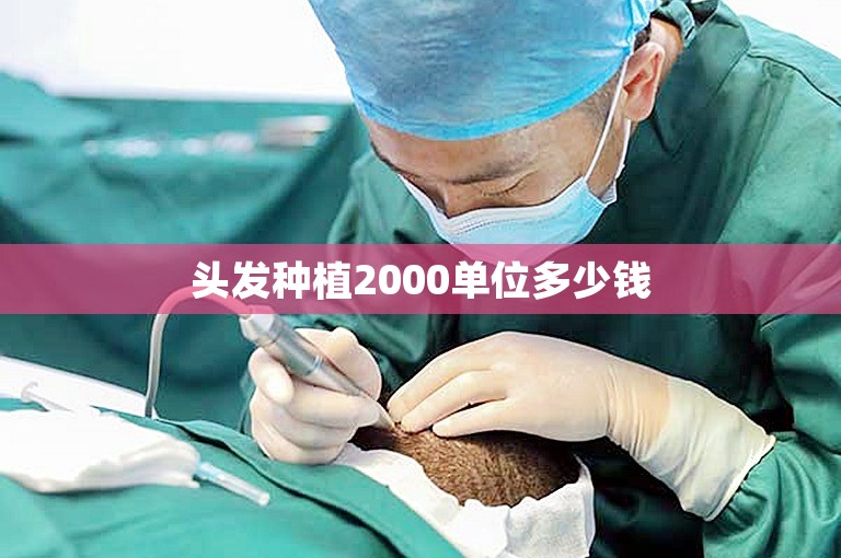 头发种植2000单位多少钱