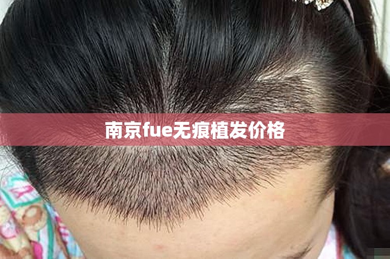 南京fue无痕植发价格