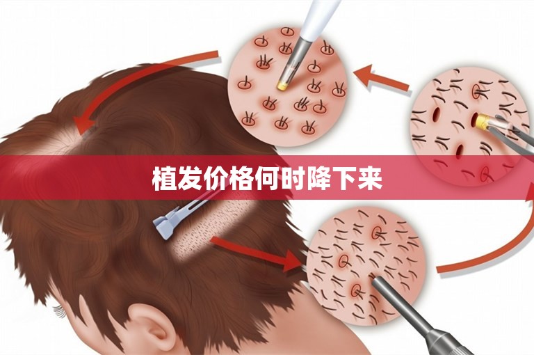 植发价格何时降下来