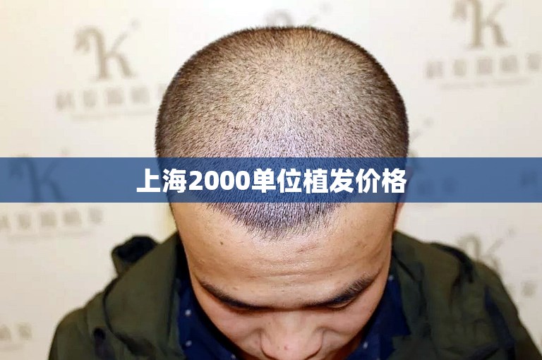 上海2000单位植发价格