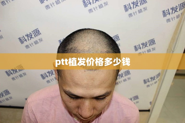 ptt植发价格多少钱