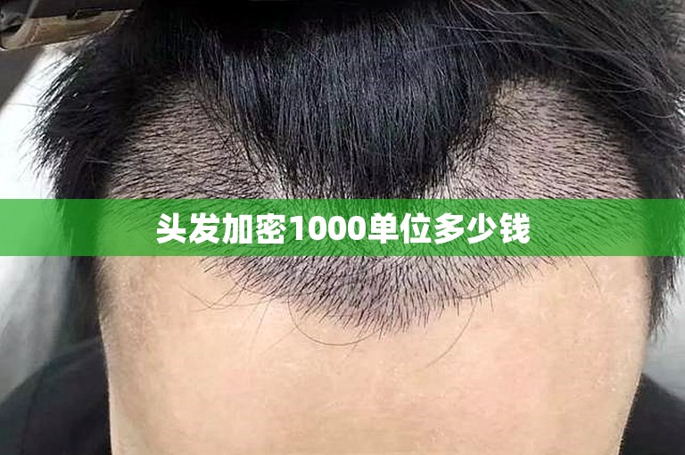 头发加密1000单位多少钱