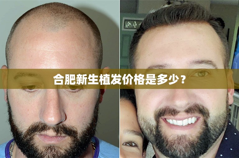 合肥新生植发价格是多少？