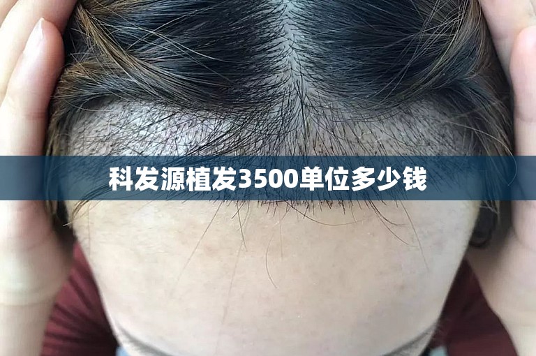 科发源植发3500单位多少钱