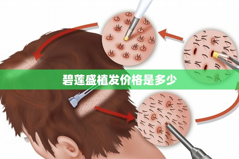 碧莲盛植发价格是多少