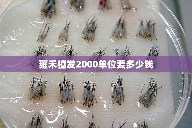 雍禾植发2000单位要多少钱