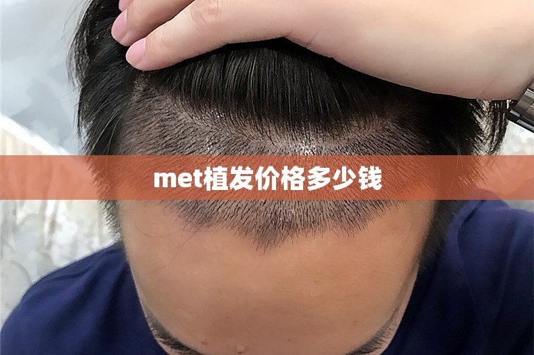 met植发价格多少钱