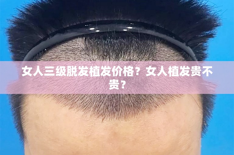 女人三级脱发植发价格？女人植发贵不贵？