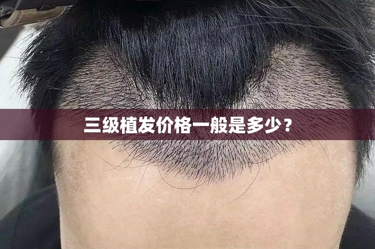 三级植发价格一般是多少？