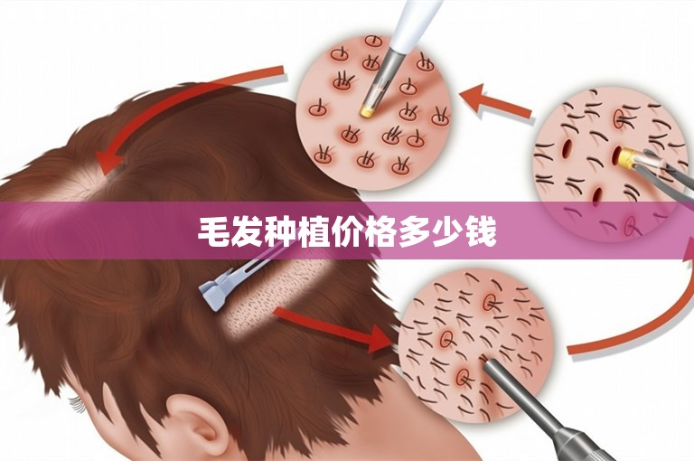 毛发种植价格多少钱