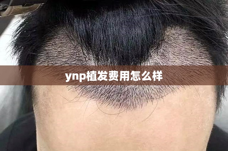 ynp植发费用怎么样