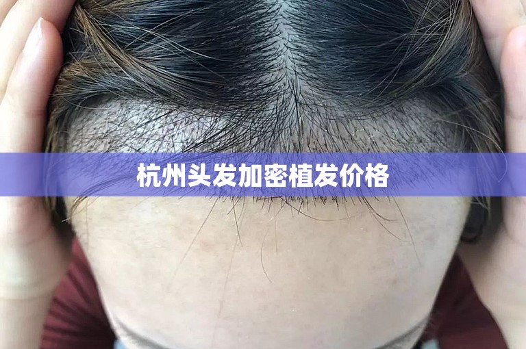 杭州头发加密植发价格