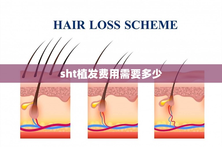 sht植发费用需要多少