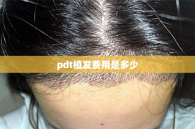 pdt植发费用是多少