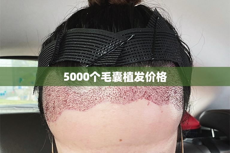 5000个毛囊植发价格