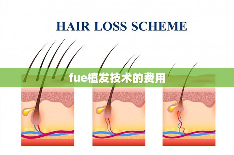fue植发技术的费用