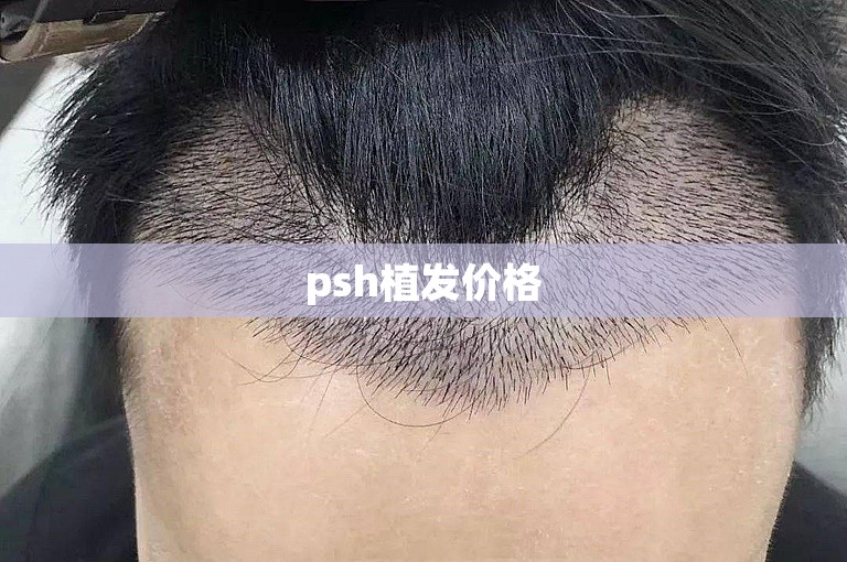 psh植发价格