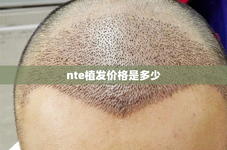 nte植发价格是多少