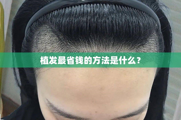 植发最省钱的方法是什么？