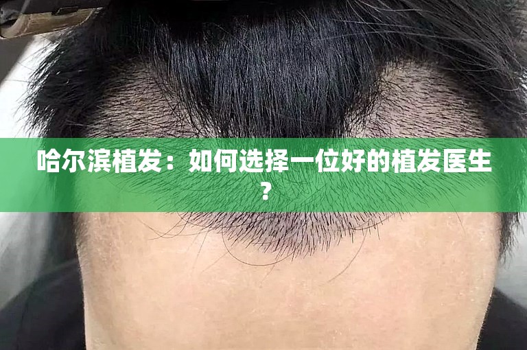 哈尔滨植发：如何选择一位好的植发医生？