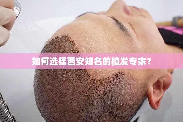 如何选择西安知名的植发专家？