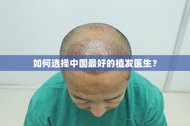 如何选择中国最好的植发医生？