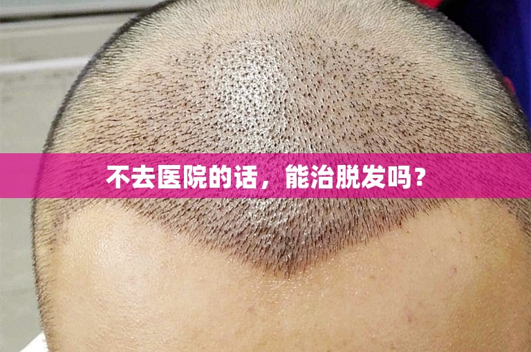 不去医院的话，能治脱发吗？