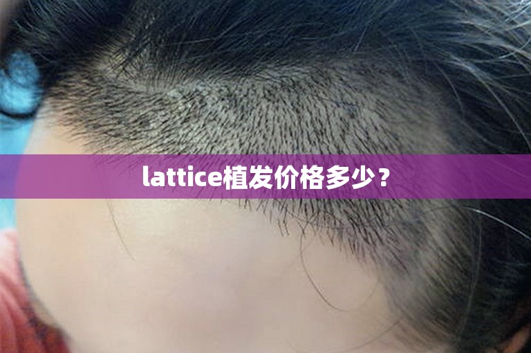 lattice植发价格多少？