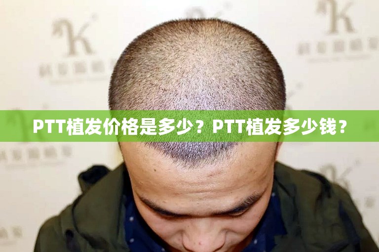 PTT植发价格是多少？PTT植发多少钱？