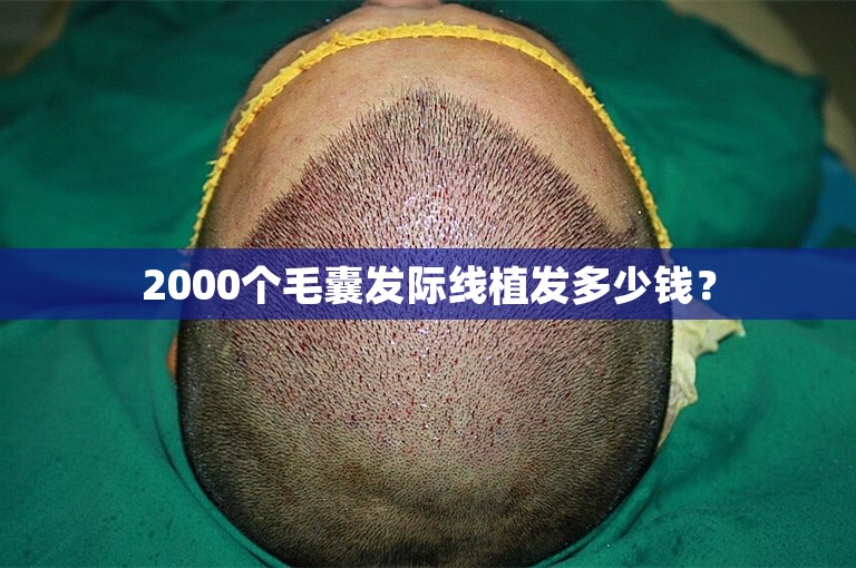 2000个毛囊发际线植发多少钱？