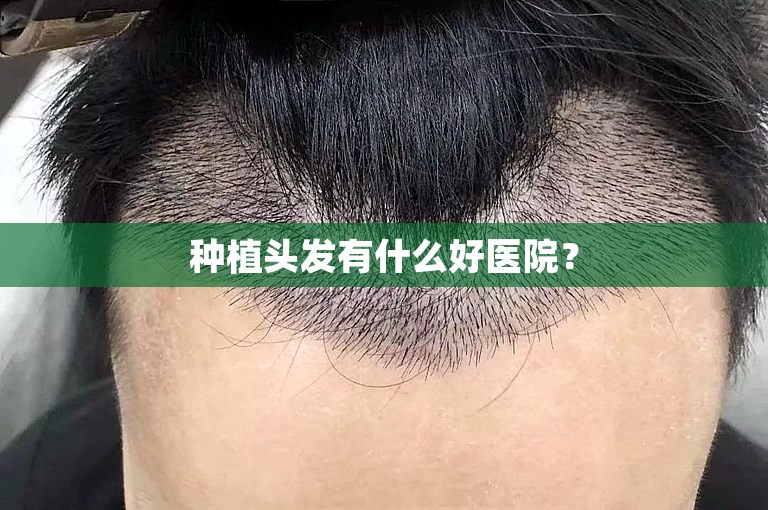 种植头发有什么好医院？