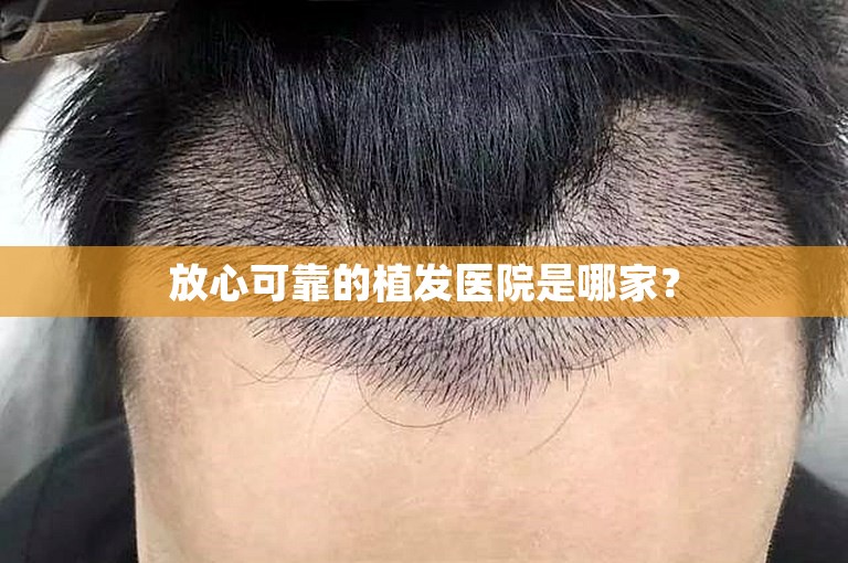 放心可靠的植发医院是哪家？