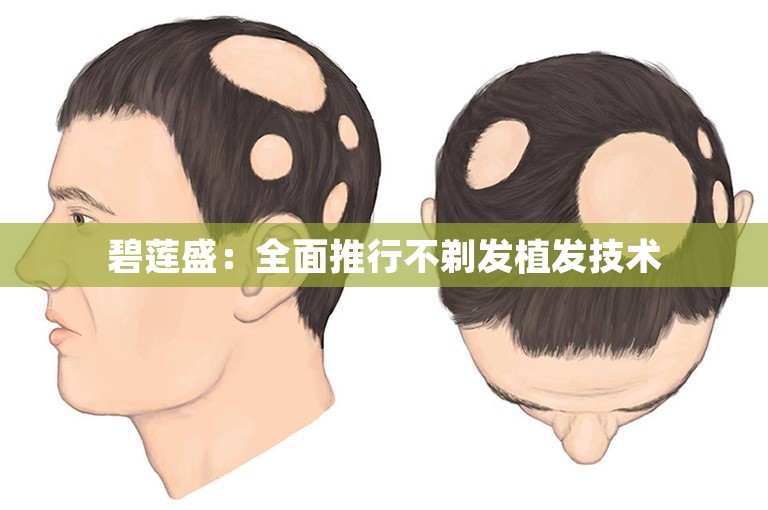 碧莲盛：全面推行不剃发植发技术