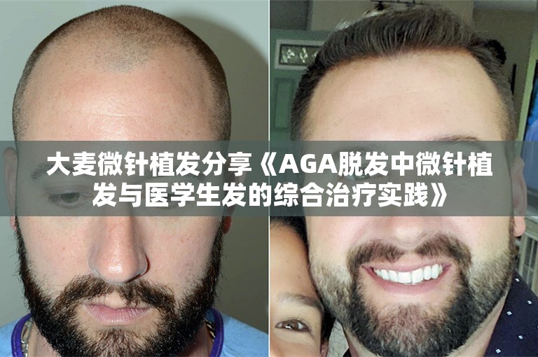 大麦微针植发分享《AGA脱发中微针植发与医学生发的综合治疗实践》