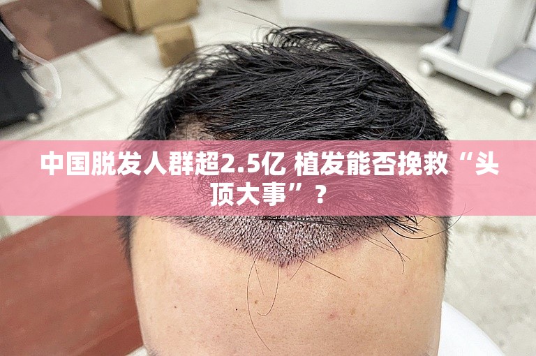 中国脱发人群超2.5亿 植发能否挽救“头顶大事”？