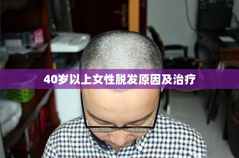 40岁以上女性脱发原因及治疗