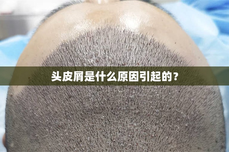 头皮屑是什么原因引起的？