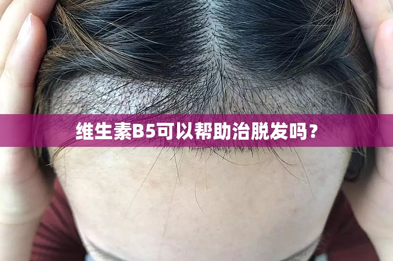 维生素B5可以帮助治脱发吗？