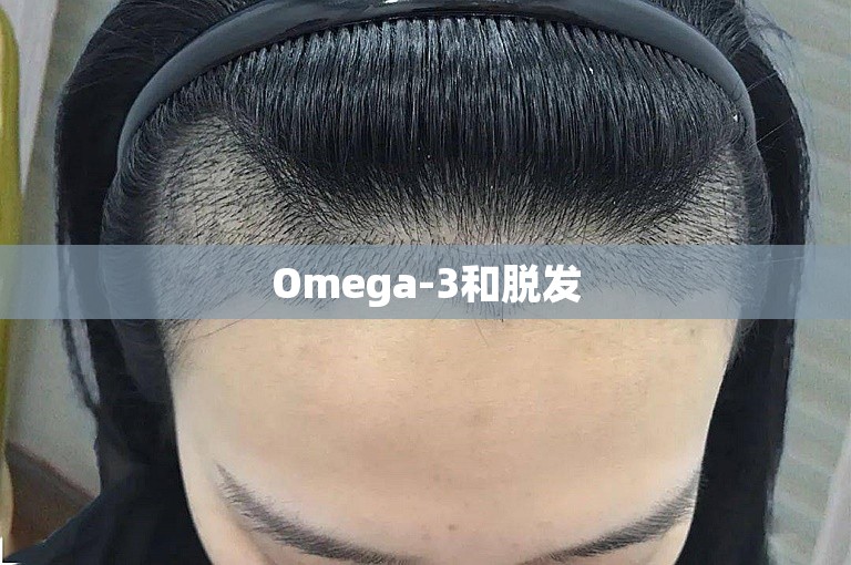 Omega-3和脱发