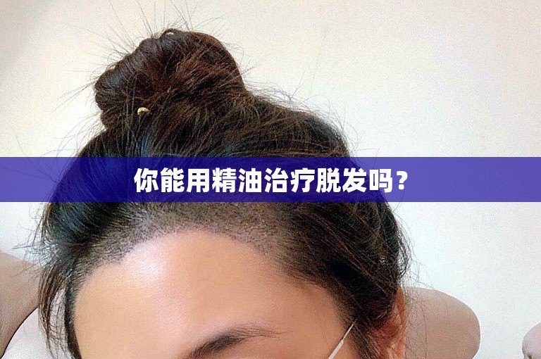 你能用精油治疗脱发吗？