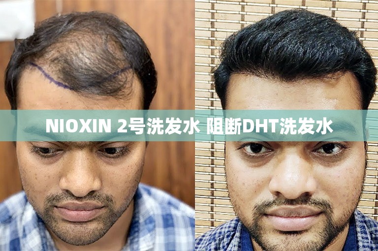 NIOXIN 2号洗发水 阻断DHT洗发水