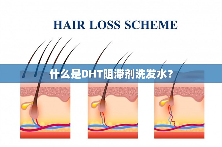 什么是DHT阻滞剂洗发水？