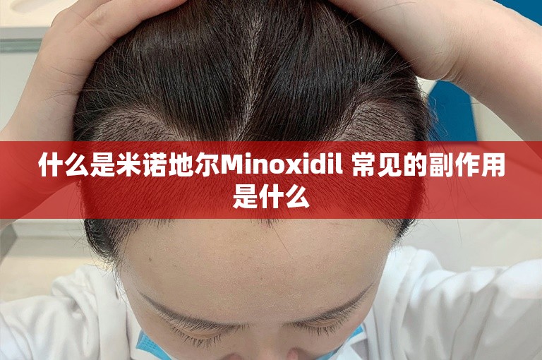 什么是米诺地尔Minoxidil 常见的副作用是什么