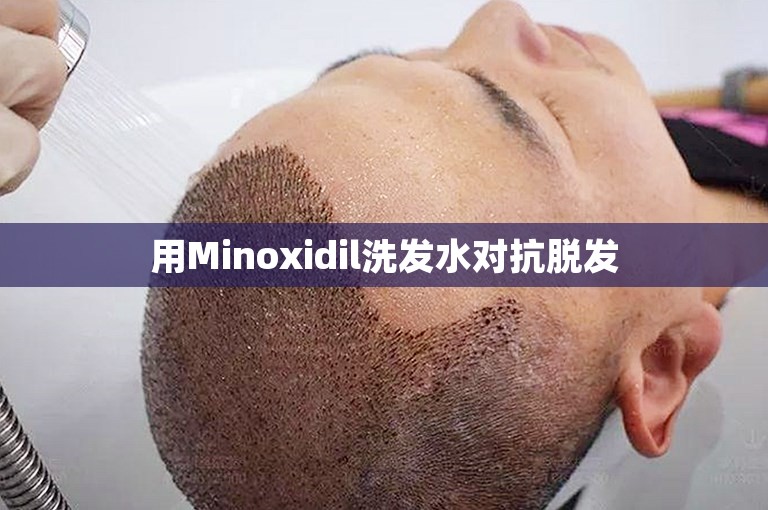 用Minoxidil洗发水对抗脱发