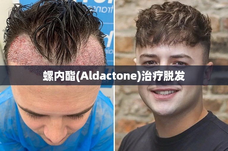 螺内酯(Aldactone)治疗脱发