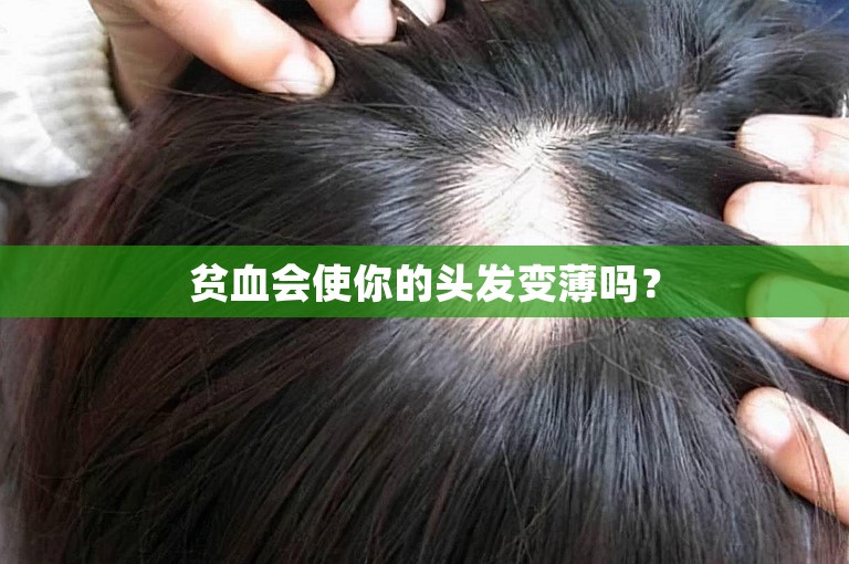 贫血会使你的头发变薄吗？