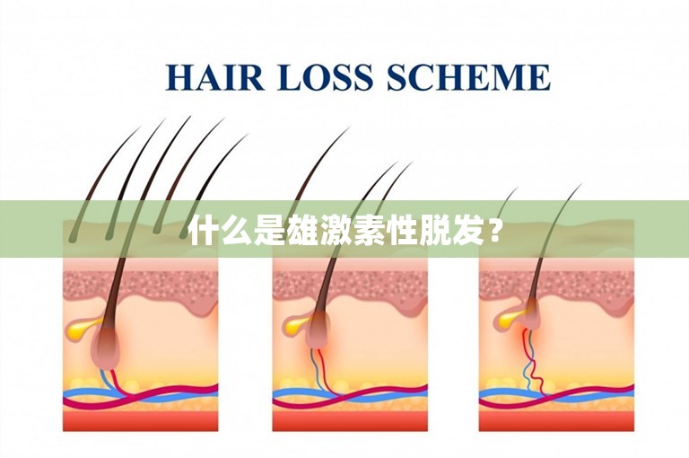 什么是雄激素性脱发？