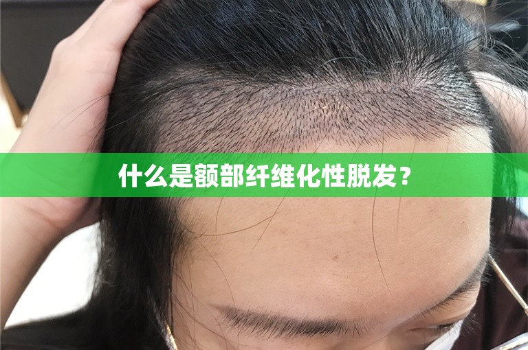 什么是额部纤维化性脱发？