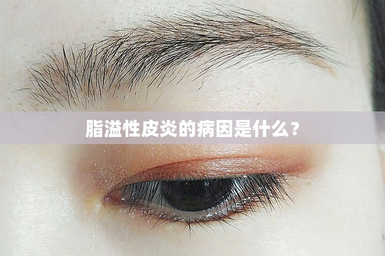 脂溢性皮炎的病因是什么？