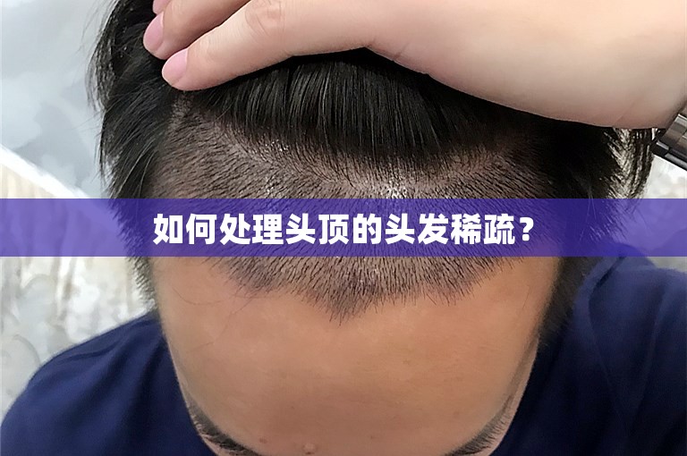 如何处理头顶的头发稀疏？